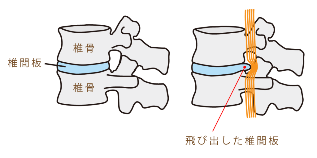 世田谷区ヘルニア整体