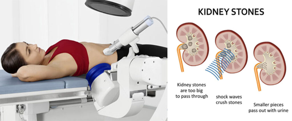 祐天寺衝撃波治療