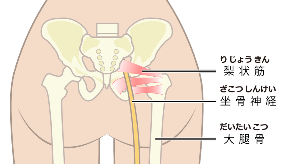 世田谷区坐骨神経痛専門整体