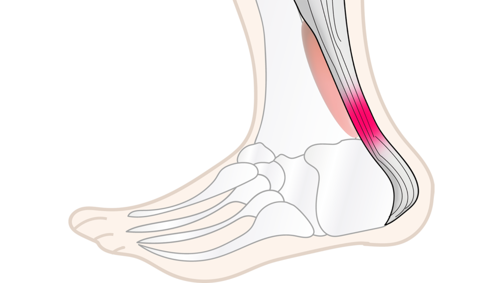 世田谷区アキレス腱外来