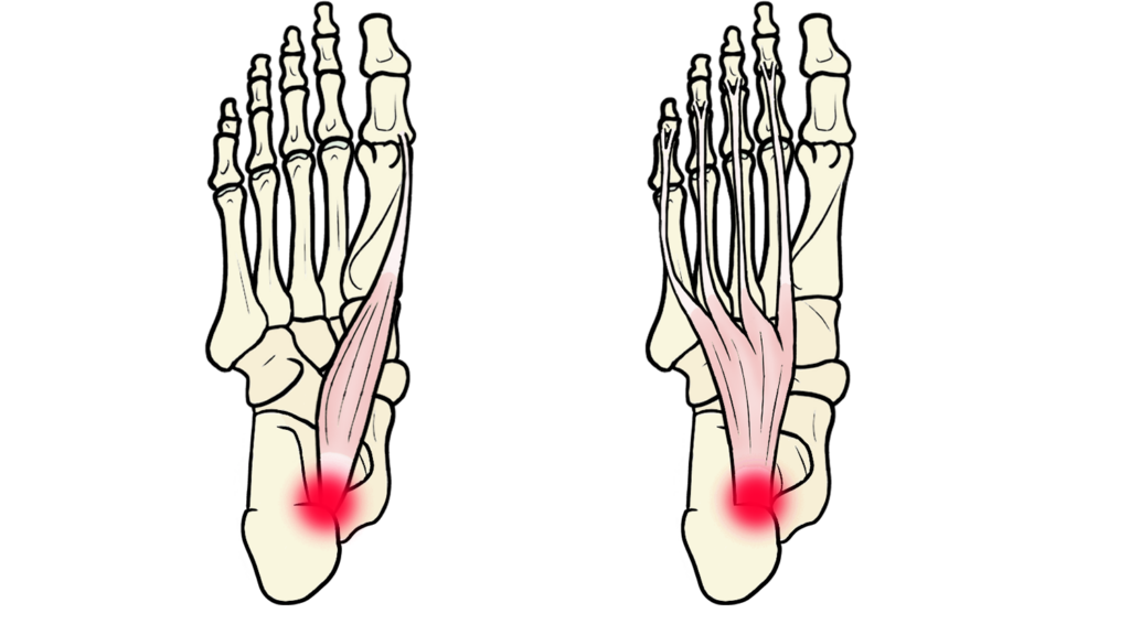 足底筋膜炎の原因