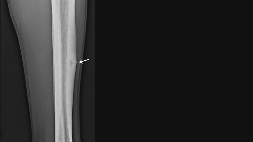 世田谷区疲労骨折