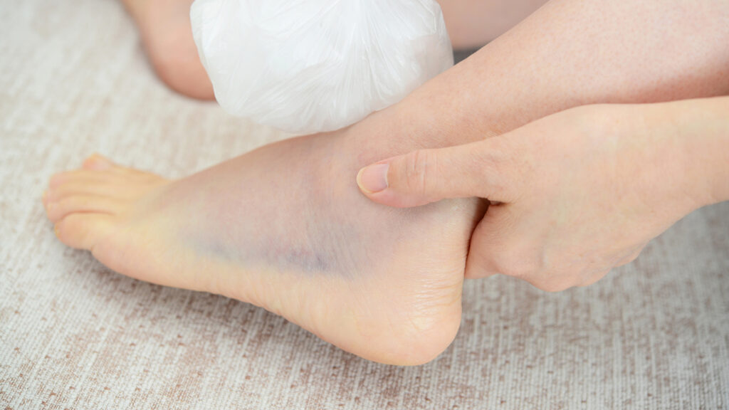 世田谷区ねんざ治療