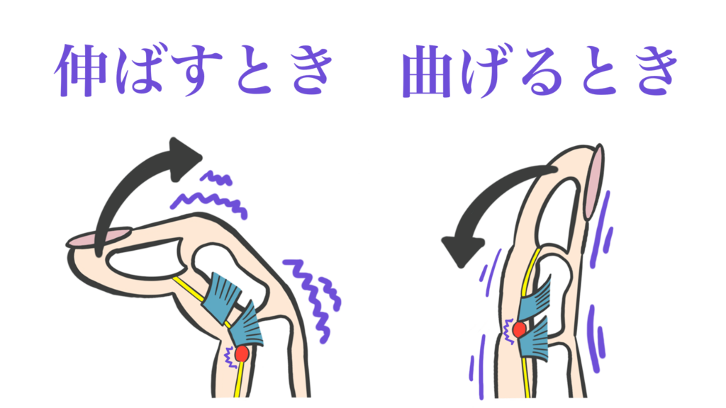 世田谷区ばね指治療